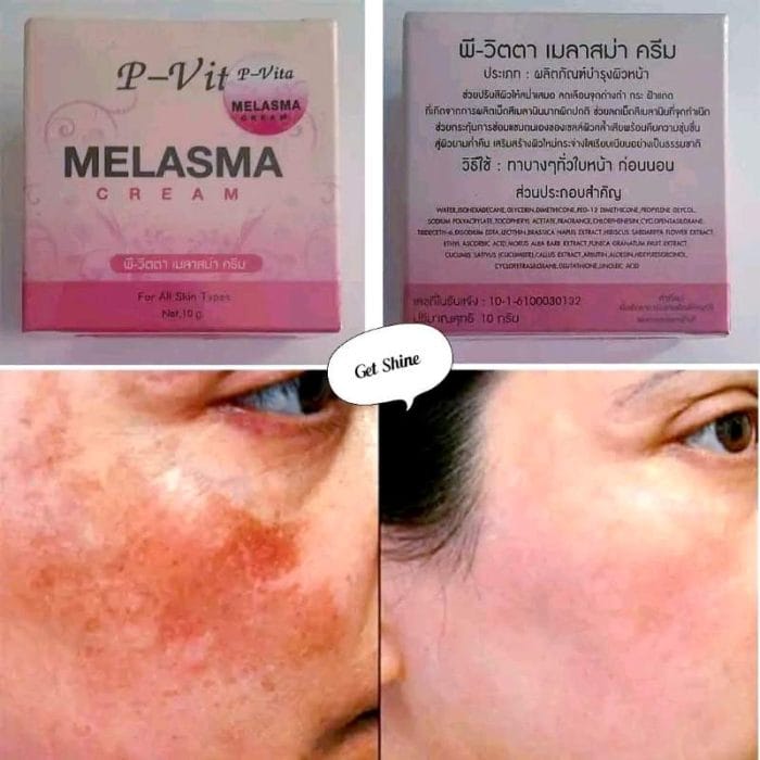 p vita melasma cream